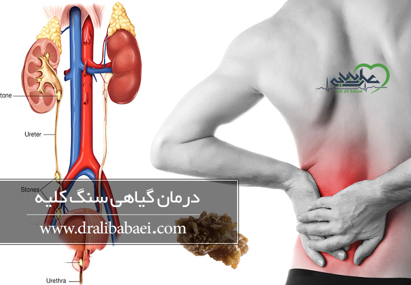 درمان سنگ کلیه به روش سنتی