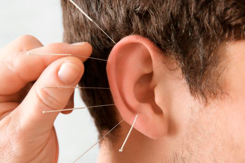 طب سوزنی گوش دکتر علی بابائی