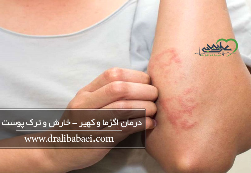 درمان اگزما و کهیر