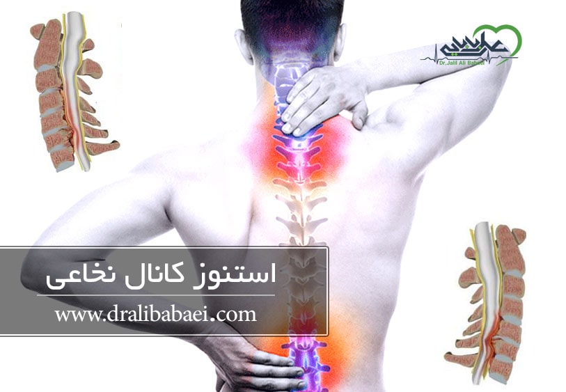 استنوز کانال نخاعی (تنگی کانال نخاعی)