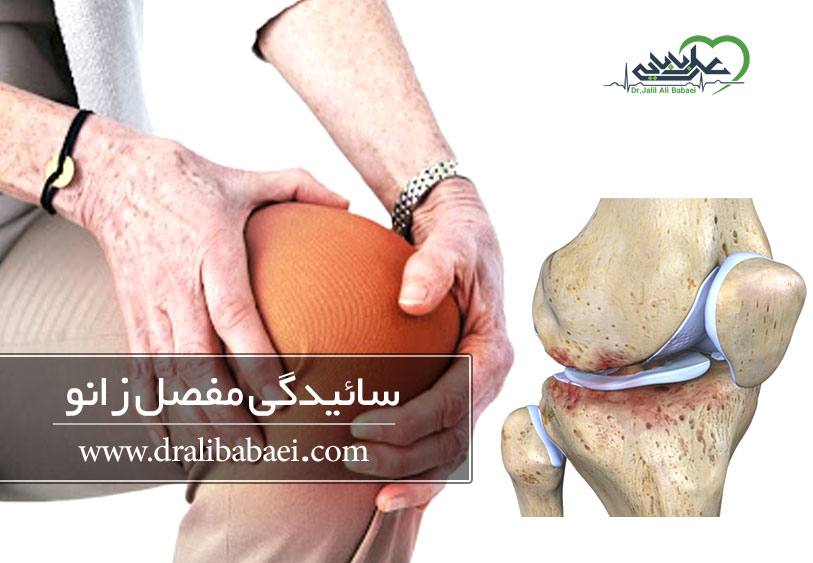 سائیدگی مفصل زانو (استئوآرتریت زانو یا آرتروز زانو)