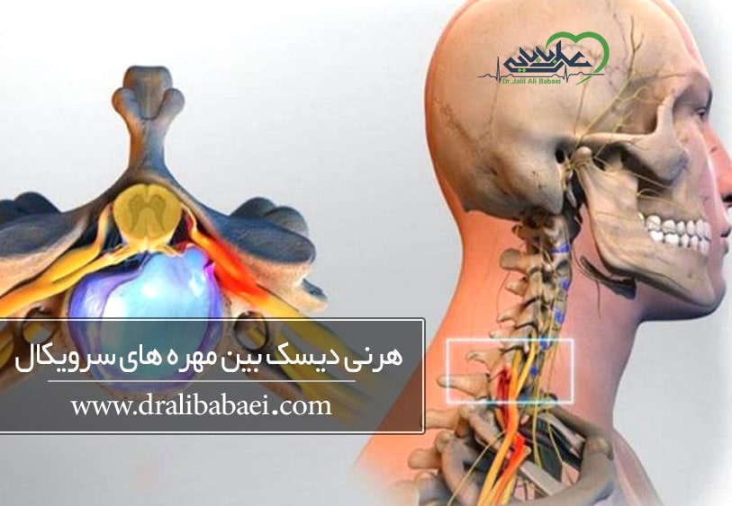فتق دیسک بین مهره ای گردن