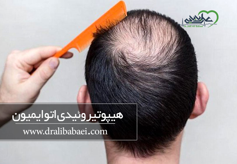 هیپوتیروئیدی