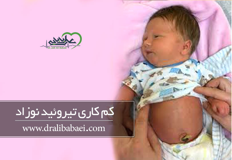 کم کاری تیروئید نوزاد یا همان هیپو تیروئیدی نوزاد