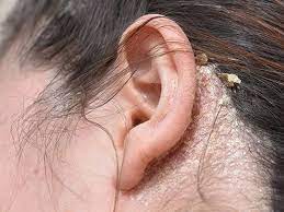 درماتیت سبورئیک