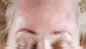 درماتیت سبورئیک