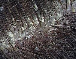 درماتیت سبورئیک