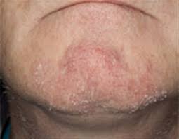 درماتیت سبورئیک