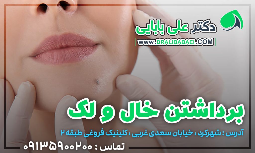 برداشتن خال