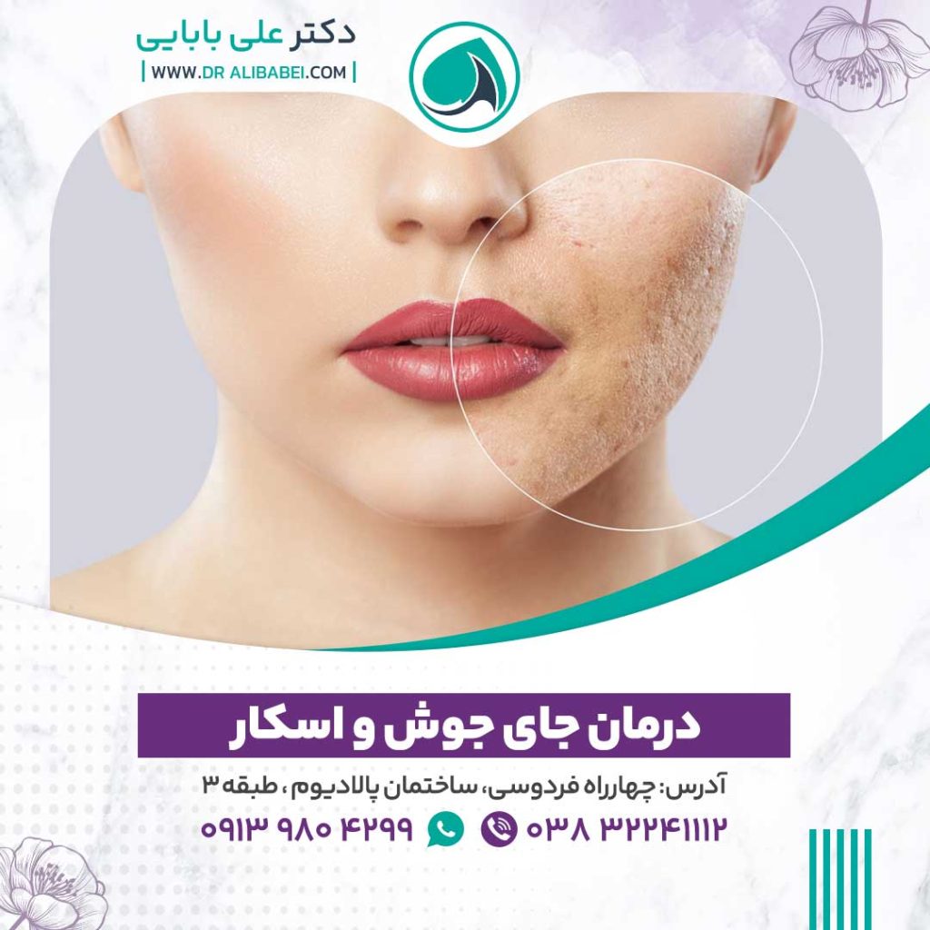 درمان جای جوش و اسکار 1024x1024