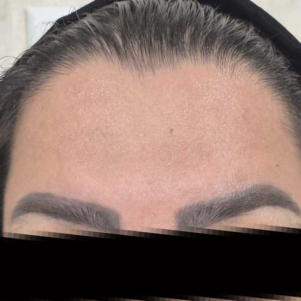 بوتاکس 8zZ 600x600