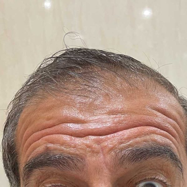 بوتاکس z2 600x600
