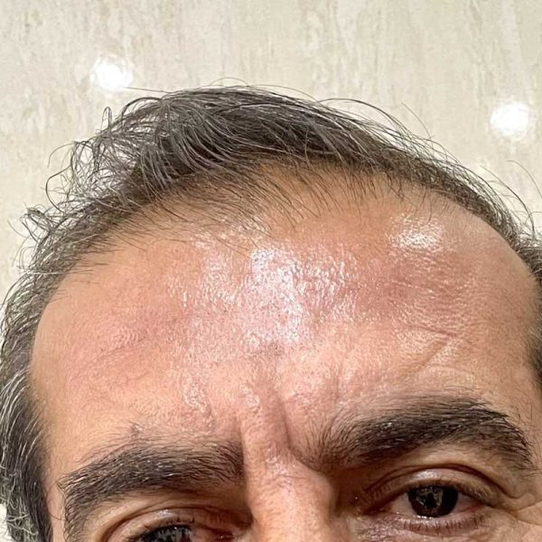 بوتاکس z21 600x600